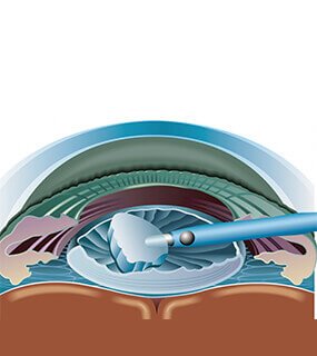 Cataract Surgery Treatment in agra