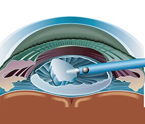 Cataract Surgery Treatment in Agra